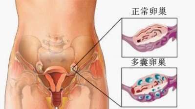 多囊卵巢人工受精的成功率不高,采取适当措施可有效提高