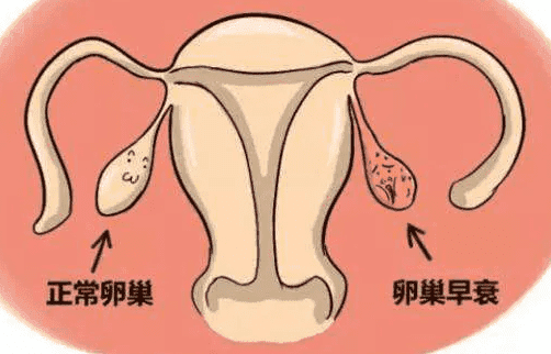  卵巢早衰还可以做试管婴儿吗？