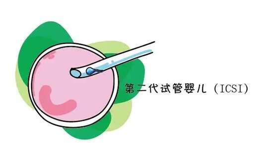 二代试管婴儿的优势和缺点