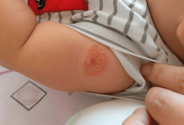 卡疤形成过程