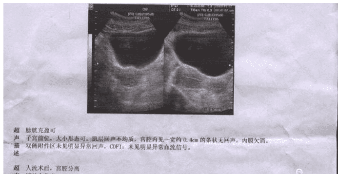 宫腔分离治疗费用及方法