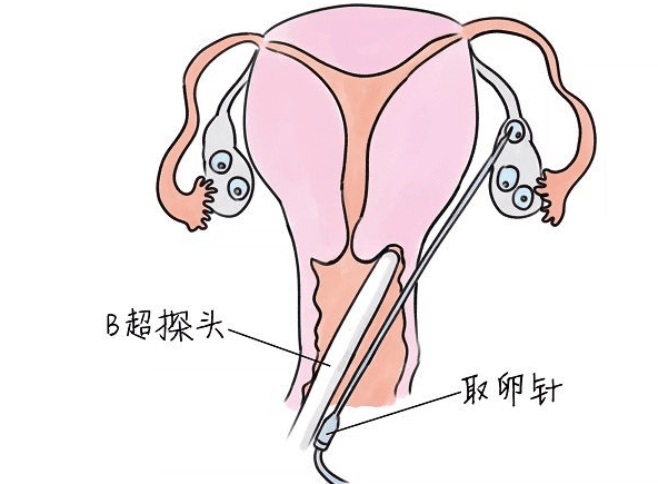 取卵后腹水的原因症状及注意事项