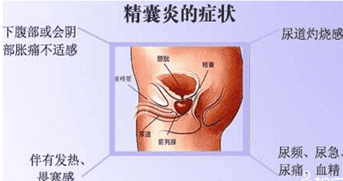精囊炎如何治疗