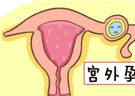 试管受精过程中为避免宫外孕，夫妇双方都应该积极采取措施
