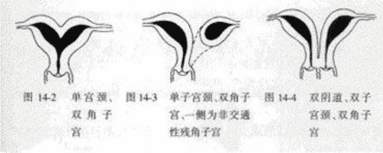 双角子宫这些危害要注意