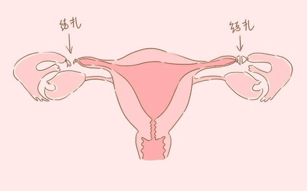 输卵管不通畅症状解读,致使女性不孕的主因之一