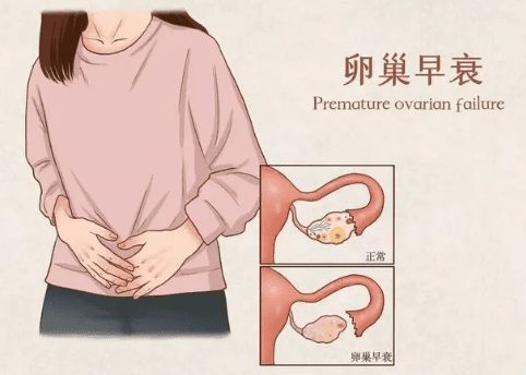 卵巢早衰到底由哪些原因导致的？