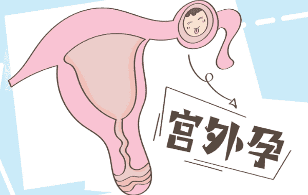 试管第二十天看到孕囊是宫内还是宫外孕吗?