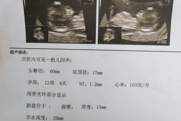 揭秘二代试管期间NT增厚的原因，和遗传、糖尿病都有关系