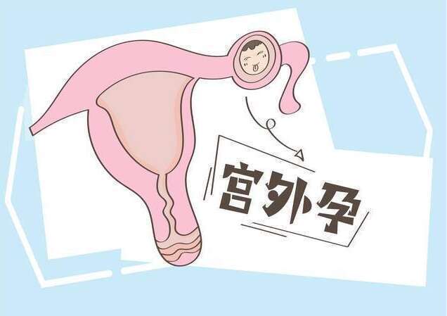 宫外孕是怎么回事?如果出现宫外孕具体有哪些危害呢?