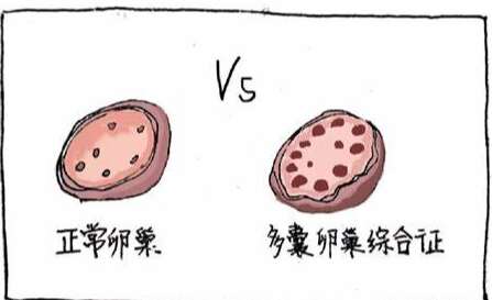 多囊卵巢综合症