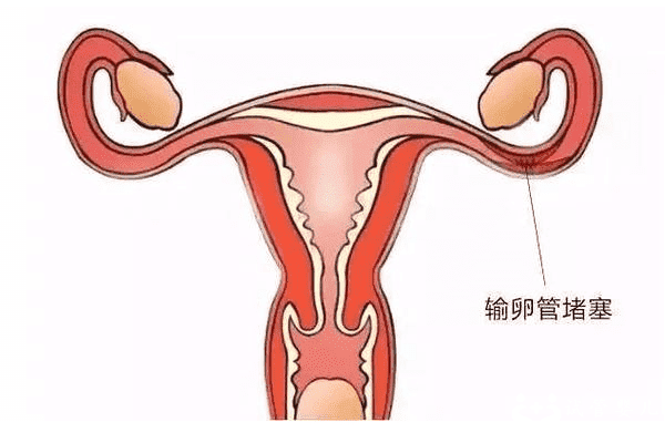 输卵管堵塞了怎么怀孕，这三种助孕方法可供选择