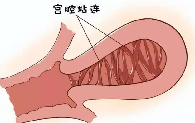 宫腔粘连是做宫腔镜还是直接试管?宫腔粘连试管前的检查项目