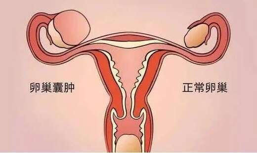试管取了卵卵巢都会有囊块吗?是卵泡没取完的自然现象