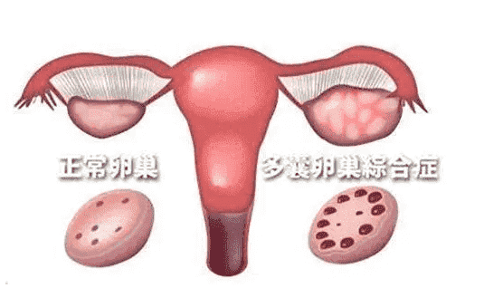 女性卵泡成熟后不破裂，该怎么办呢?