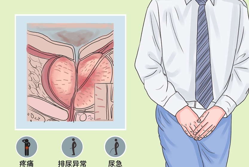 前列腺炎对试管婴儿的影响有哪些