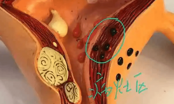 试管移植前有轻微腺肌症需不需要治疗和降调?