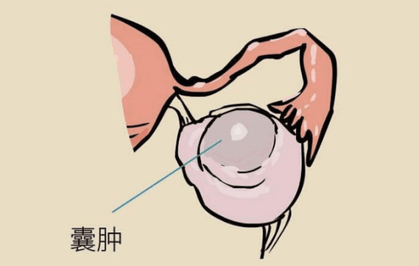 巧囊术后半年没怀孕需要试管还是人授?