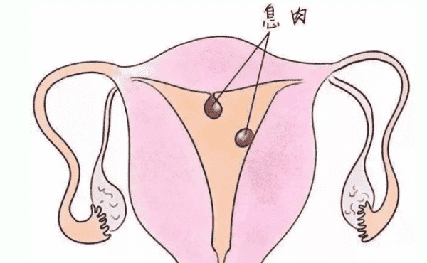 试管婴儿促排补充雌激素容易导致息肉?