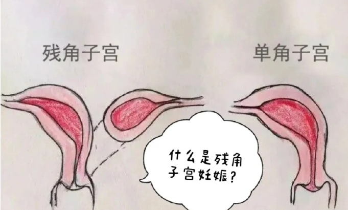 女性出现右侧残角子宫可以试管婴儿吗?	