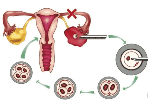 取卵后女性一定会出现腹水的情况吗？