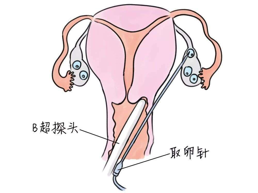 进行试管婴儿治疗，从周期开始到取卵需要多长时间？