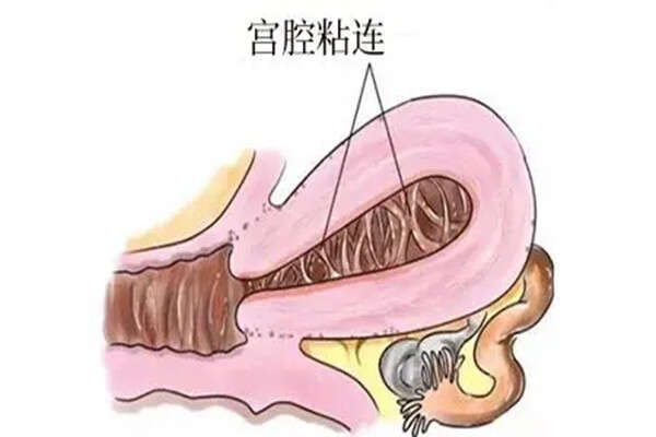 宫颈粘连做试管长方案和微刺激促排哪个成功率高？