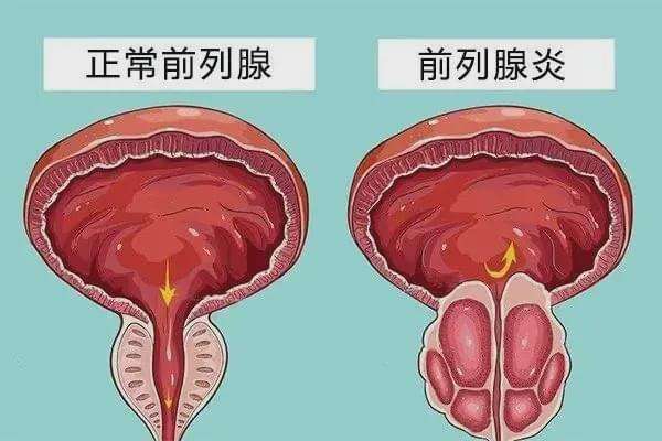 前列腺钙化做三代试管移植前胚胎筛查需要多长时间？