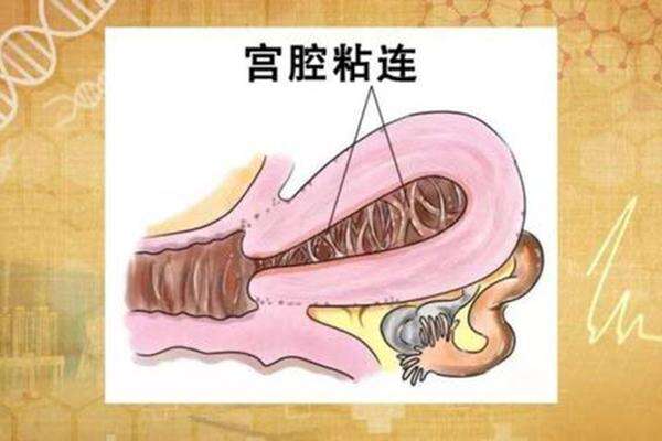 宫腔粘连在泰国做试管婴儿费用是怎么样的？