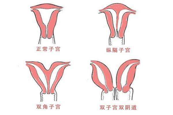 完全纵隔子宫试管失败两次，第三次移植会成功吗？