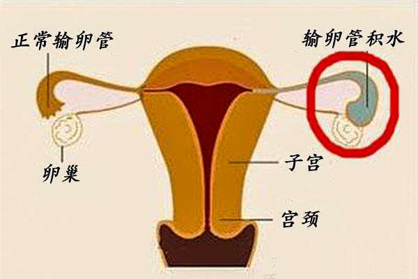 输卵管积水3cm试管人工周期内膜转化大概需要几天的时间？