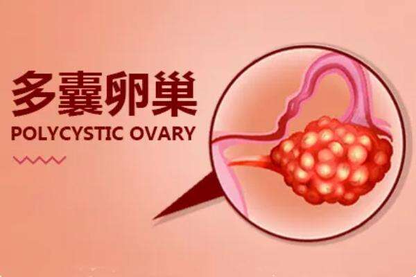 多囊卵巢试管婴儿成功率大吗？