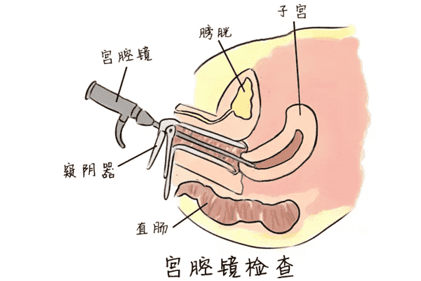 宫腔粘连在济南做试管婴儿怎么样？
