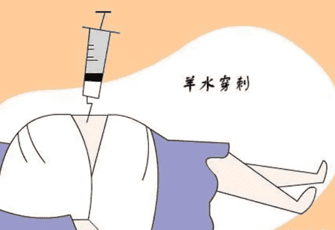 羊水穿刺检查具体的操作步骤和注意事项有哪些？