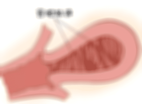 患有宫腔粘连做试管婴儿会影响胚胎发育吗？