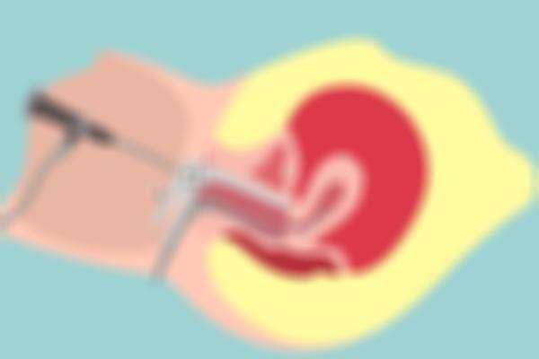 子宫内膜息肉在石家庄做试管婴儿怎么样？是否有其他选择？