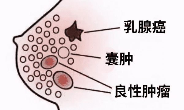 甲亢去马来西亚吉隆坡医院做试管要花费多少钱？费用明细是怎么样的