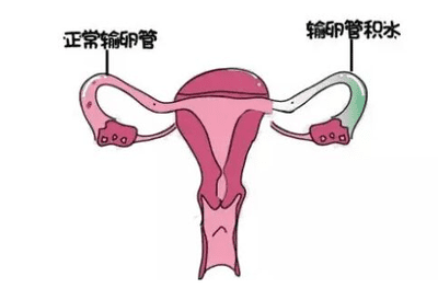 巧克力囊肿去江苏做试管可以吗？流程是怎么样的