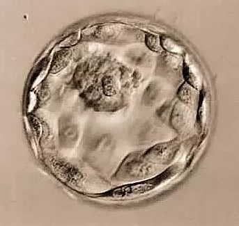 腺肌症去泰国做三代试管麻烦吗？需要花费多少钱