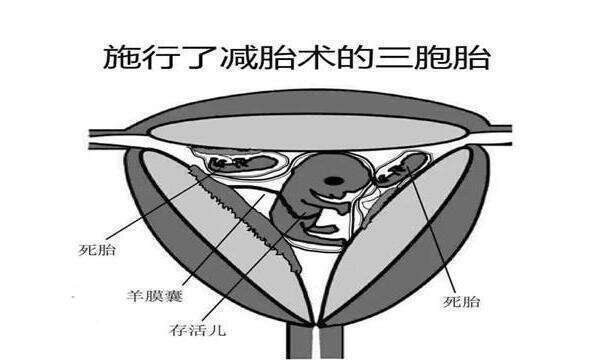 糖尿病在泰国做三代试管的步骤有哪些？15万元够做三代吗