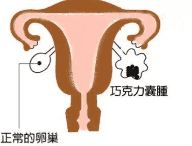 腺肌症在北京做三代试管的流程是怎么样的？三代试管攻略大全