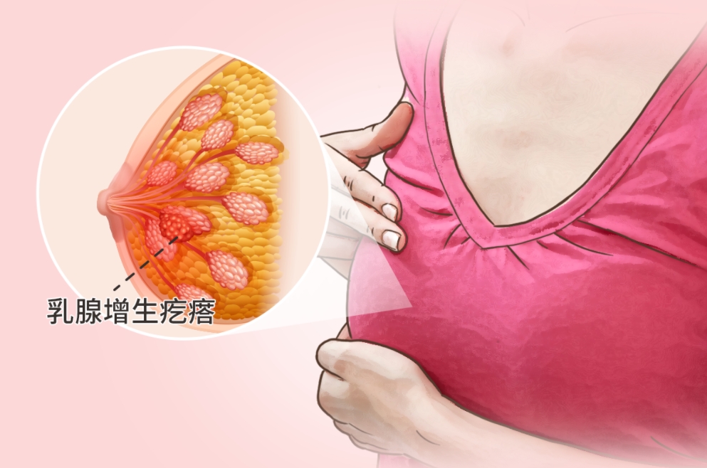 糖尿病在浙江做三代需要花费多少钱？钱都花在了哪些地方