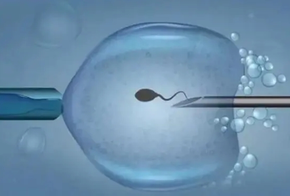 2025年hiv患者做三代试管的步骤有哪些？三代试管攻略大全