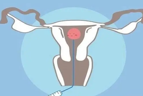 陕西做第二代试管婴儿需要多少钱？需要注意哪些问题？
