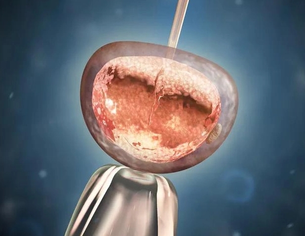 泰国艾滋病试管婴儿多少钱？附hiv洗精+三代费用明细