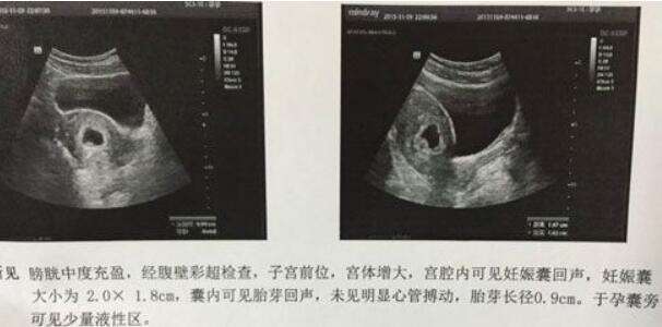 淮南市艾滋病做试管哪家医院好，费用多少钱？