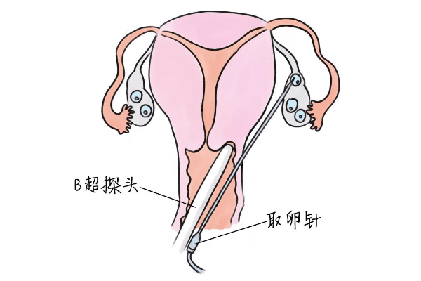 中美泰三国试管婴儿的费用对比明细