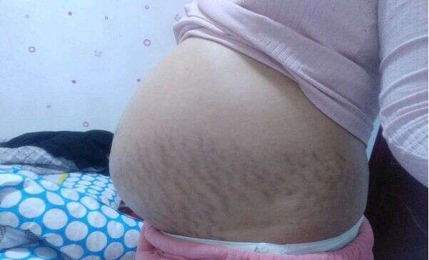试管婴儿减胎术什么时间进行最合适？又是怎样进行的呢？