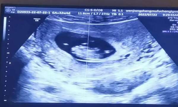 哪些因素可以提高试管婴儿成功概率