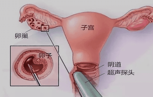 试管第二代成功率高吗？